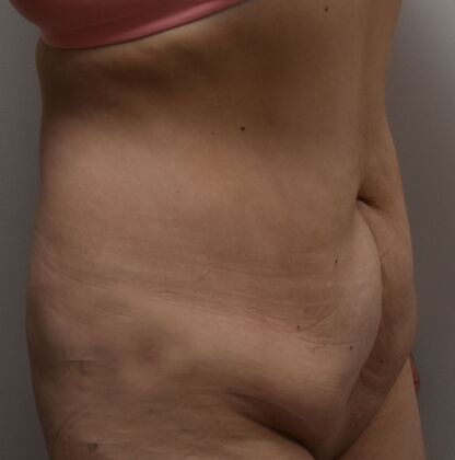 Tummy Tuck (Abdominoplasty): Case 369 - Before