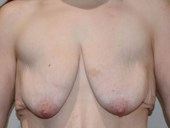 Massive Weight Loss : Case 110 - Before