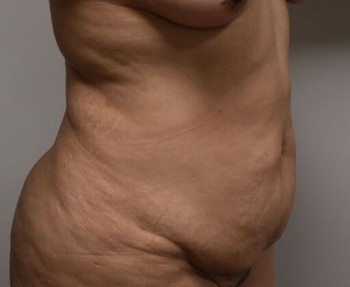 Tummy Tuck (Abdominoplasty): Case 379 - Before