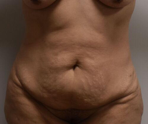 Tummy Tuck (Abdominoplasty): Case 379 - Before