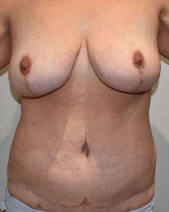 Mommy Makeover Case 223 - After