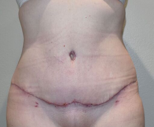 Tummy Tuck (Abdominoplasty): Case 380 - After