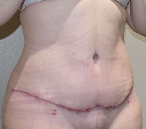 Tummy Tuck (Abdominoplasty): Case 380 - After