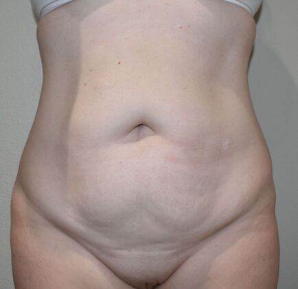 Tummy Tuck (Abdominoplasty): Case 380 - Before