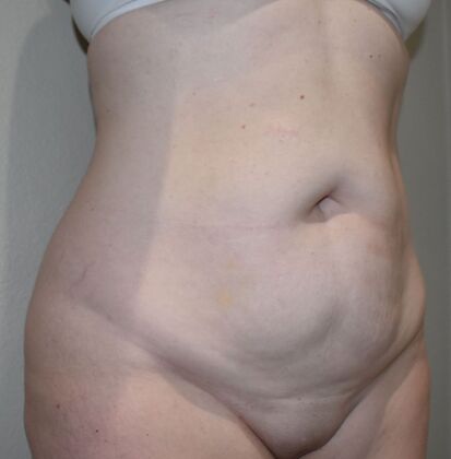 Tummy Tuck (Abdominoplasty): Case 380 - Before