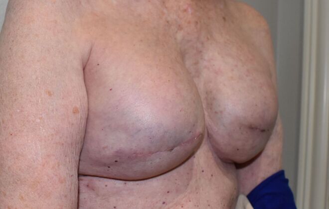 Breast Reconstruction: Case 81 - After