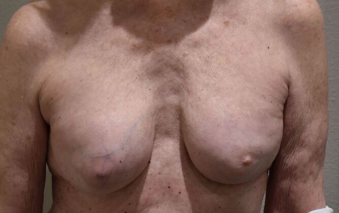 Breast Reconstruction Case 81 - Before