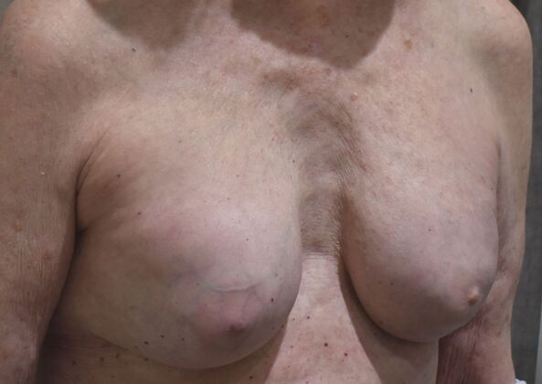Breast Reconstruction: Case 81 - Before