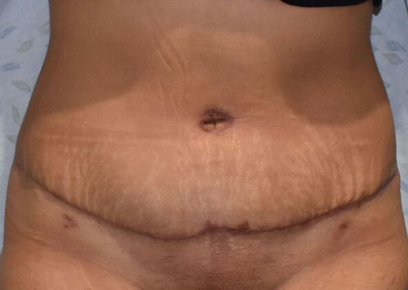 Tummy Tuck (Abdominoplasty): Case 381 - After