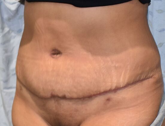 Tummy Tuck (Abdominoplasty): Case 381 - After