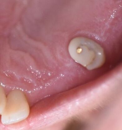 Crowns Case 27 - El Campo, TX - Before