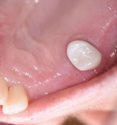 Crowns Case 27 - El Campo, TX - After