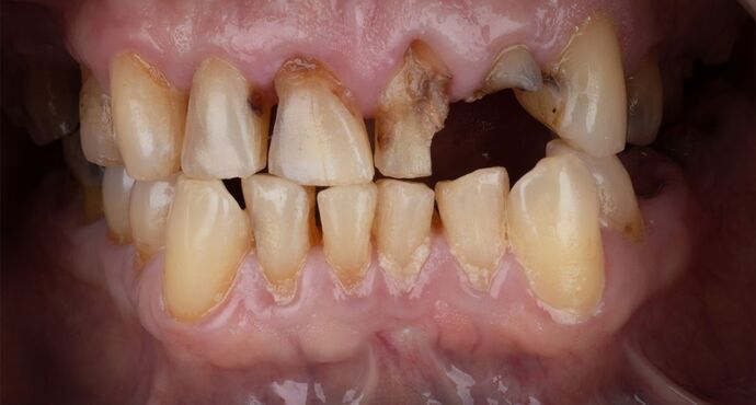 Our Results: UPPER-LOWER ALL ON 6 THEETH IN A DAY - Before