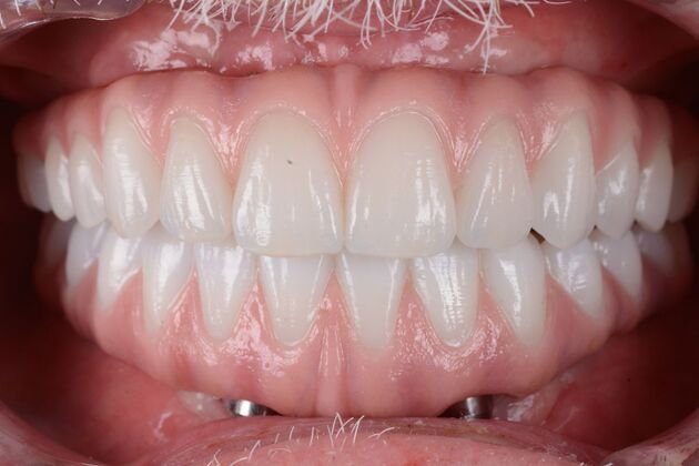 Our Results: UPPER-LOWER ALL ON 6 THEETH IN A DAY - After, zirconia final prosthesis 