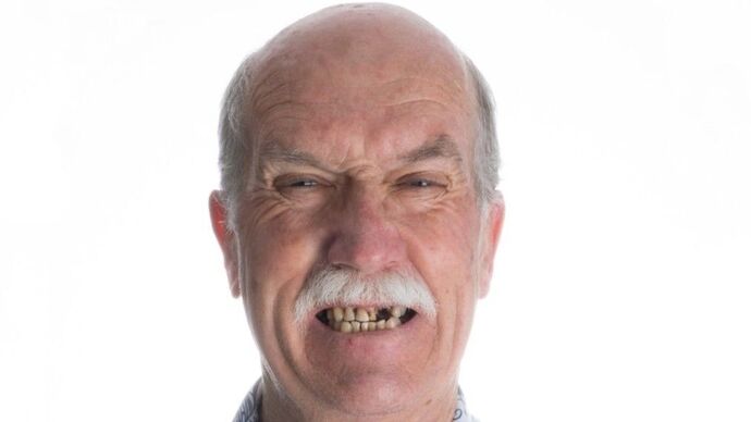 Our Results UPPER-LOWER ALL ON 6 THEETH IN A DAY - Before