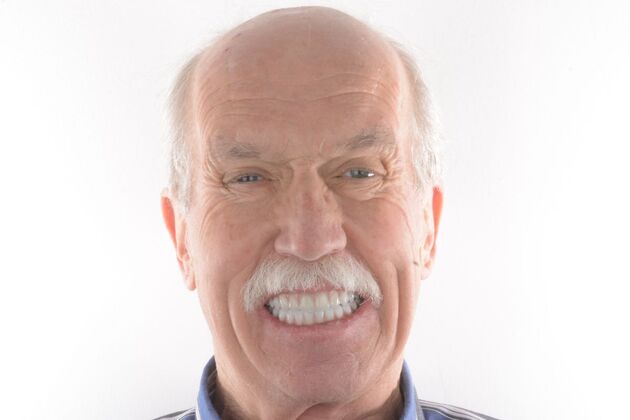 Our Results UPPER-LOWER ALL ON 6 THEETH IN A DAY - After