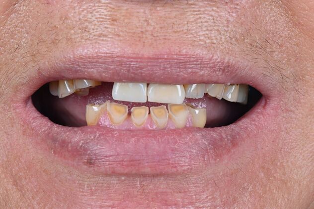 Full Mouth Rehabilitation Case 1 - Before