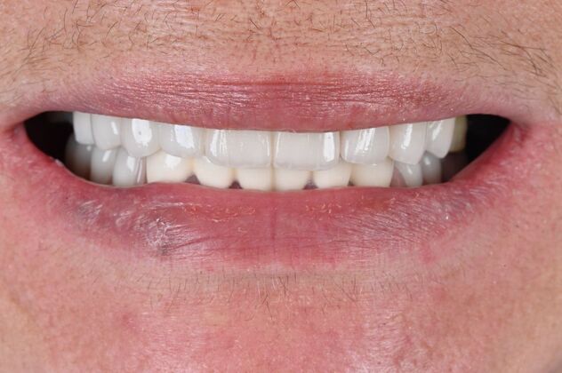 Full Mouth Rehabilitation Case 1 - After