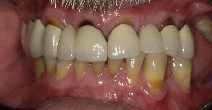 Full Mouth Rehabilitation Case 2 - Before