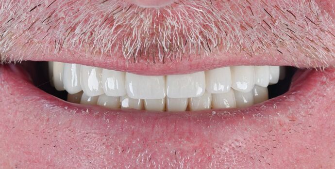 Full Mouth Rehabilitation Case 2 - After