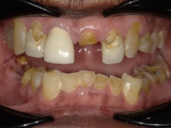 Full Mouth Rehabilitation Case 3 - Before