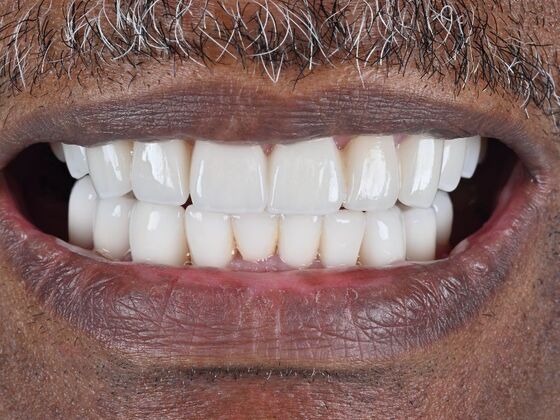 Full Mouth Rehabilitation Case 3 - After