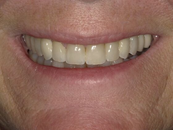 Full Mouth Rehabilitation Case 4 - After