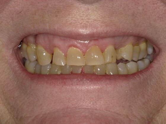 Full Mouth Rehabilitation Case 4 - Before