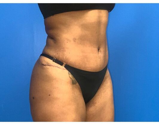 Abdominoplasty Case 29 - After