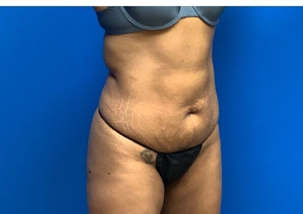 Abdominoplasty Case 29 - Before
