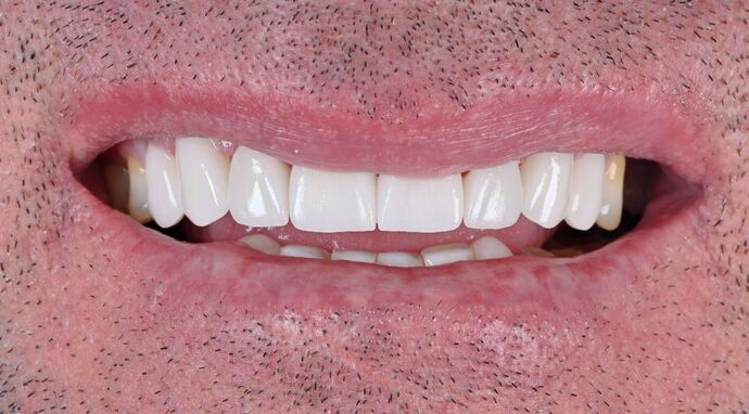 Cosmetic Cases Case 4 - After