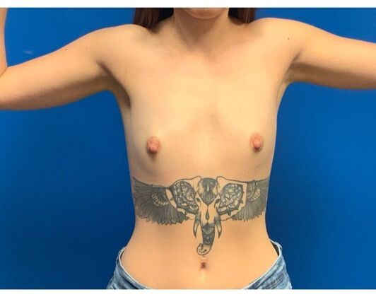 Breast Augmentation Case 36 - Before