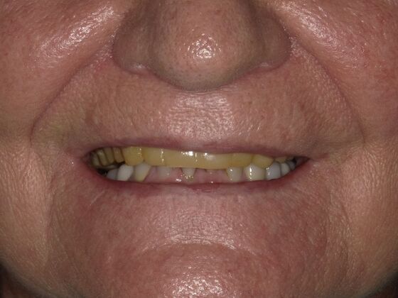 Dental Implant Dentures: Case 2 - Before
