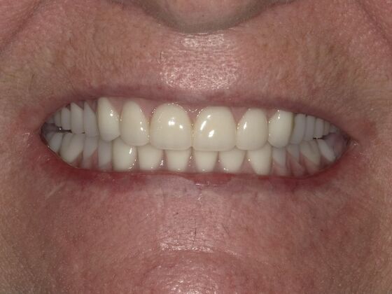 Dental Implant Dentures: Case 2 - After