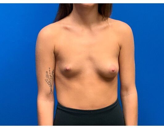 Breast Augmentation Case 37 - Before