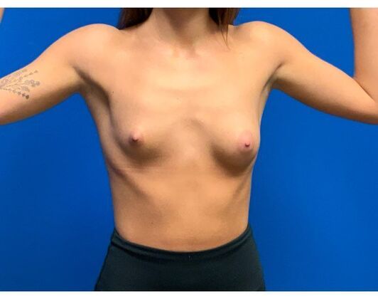 Breast Augmentation: Case 37 - Before