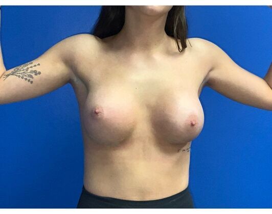 Breast Augmentation: Case 37 - After