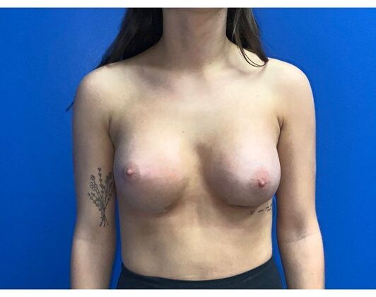 Breast Augmentation Case 37 - After