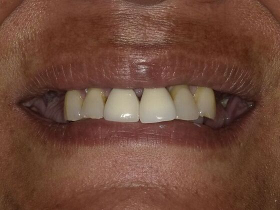 Dental Implant Dentures: Case 3 - Before