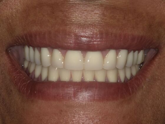 Dental Implant Dentures: Case 3 - After