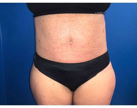 Abdominoplasty Case 30 - After
