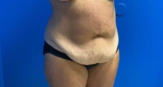 Abdominoplasty Case 30 - Before