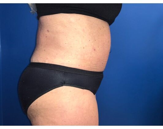 Abdominoplasty: Case 30 - After