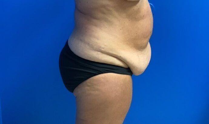 Abdominoplasty: Case 30 - Before