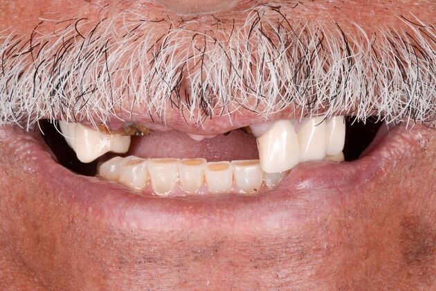 Our Results: UPPER ALL ON 6 TEETH IN A DAY - Before surgery