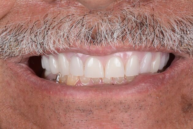 Our Results: UPPER ALL ON 6 TEETH IN A DAY - After surgery immediate load healing fixed temps