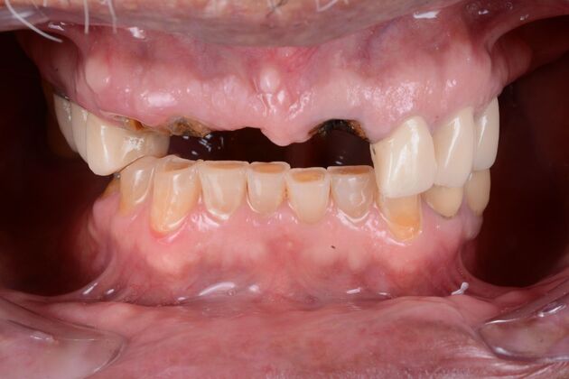 Our Results: UPPER ALL ON 6 TEETH IN A DAY - Before surgery
