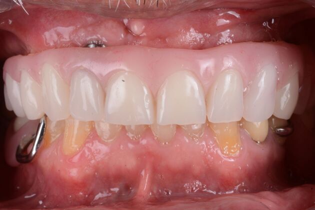 Our Results: UPPER ALL ON 6 TEETH IN A DAY - after surgery immediate load healing fixed temps