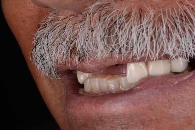 Our Results: UPPER ALL ON 6 TEETH IN A DAY - Before surgery