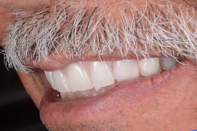 Our Results: UPPER ALL ON 6 TEETH IN A DAY - after surgery immediate load healing fixed temps